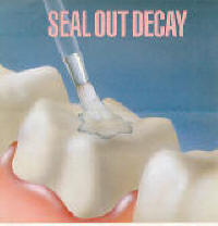 dental sealants-02